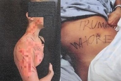 [서울=뉴시스] 전직 공화당 보좌관 나탈리 그린(26)이 몸에 난 상처와 낙서. (사진 출처: 뉴욕포스트 캡처)2025.12.04.