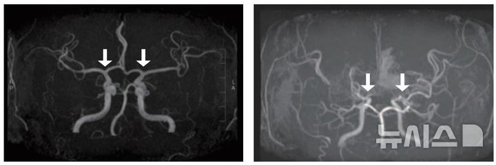 [서울=뉴시스] 사진 왼쪽부터 정상 및 모야모야병 환자의 뇌혈관. (사진= 서울대병원 제공)