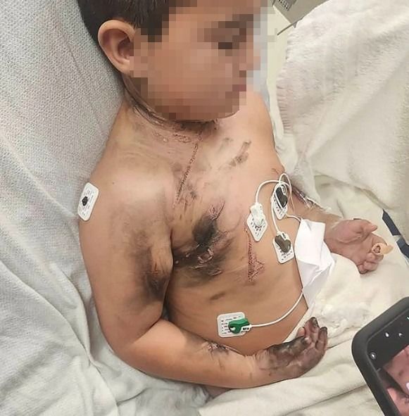 [뉴시스]감전 사고를 당해 온 몸이 검게 그을렸다. (사진 = 피플 캡처) *재판매 및 DB 금지