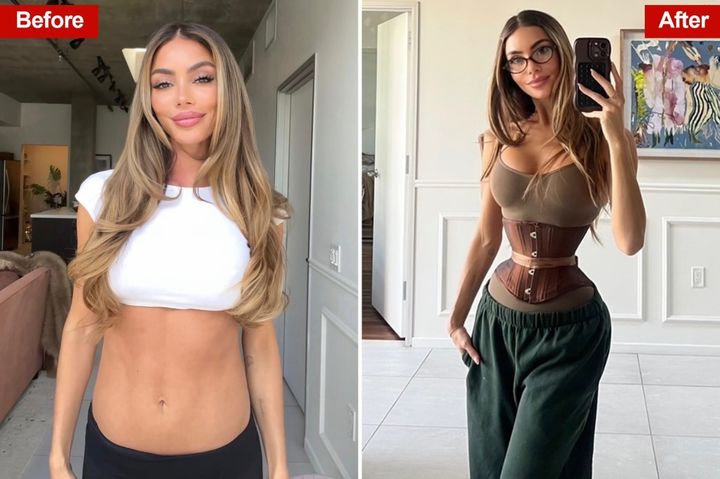 [서울=뉴시스]갈비뼈 리모델링 수술을 받은 에나 셸의 수술 전후 모습. (사진출처: 뉴욕포스트 캡처) 2025.12.05.