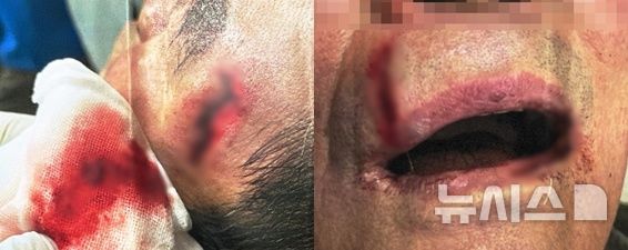 [단양=뉴시스] B씨가 입은 상처 (사진= 독자 제공) photo@newsis.com *재판매 및 DB 금지