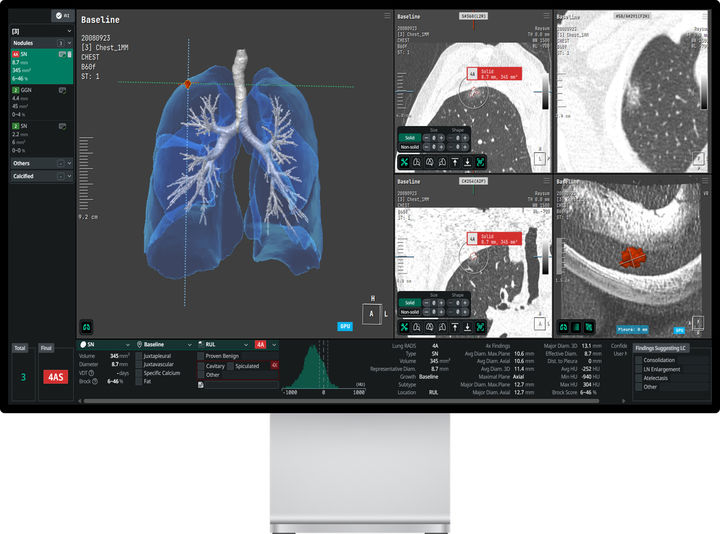 [서울=뉴시스] 코어라인소프트는 아이디엔에이(iDNA), 에라스무스 의과대학(Erasmus MC), 흐로닝언 대학교(University of Groningen) 등과 공동 수행한 폐암 검진 연구가 유럽 암학회지 EJC(European Journal of Cancer)에 게재되며, AI 기반 폐암 스크리닝 기술이 베이스라인과 추적검사 단계 모두에서 유효성을 확인했다고 16일 밝혔다. (사진=코어라인소프트 제공) 2025.12.16. photo@newsis.com *재판매 및 DB 금지