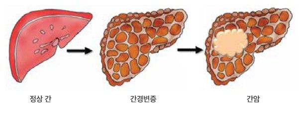 [서울=뉴시스] 20일 염증과 손상으로 이미 병든 간에서 더욱 잘 발생하는 간암의 최신 치료 전략부터 예방 방법까지 유수종 서울대병원 소화기내과 교수의 도움말로 알아봤다. (사진=서울대병원 제공) 2025.12.19. photo@newsis.com *재판매 및 DB 금지