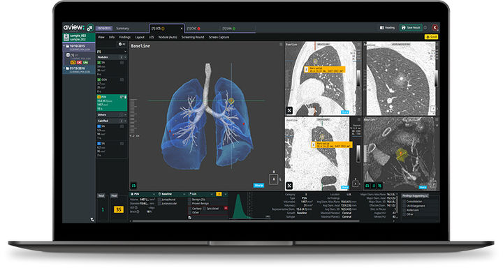 [서울=뉴시스] 의료 인공지능(AI) 기업 코어라인소프트는 흉부 컴퓨터 단츨촬영(CT)의료영상에서 폐결절 악성 종양 여부 진단 보조 소프트웨어 '에이뷰(AVIEW) LCS'가 산업통상자원부의 우수연구개발 혁신제품으로 지정됐다고 29일 밝혔다. (사진=코어라인소프트 제공) 2025.12.29. photo@newsis.com *재판매 및 DB 금지