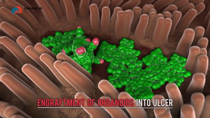 [서울=뉴시스] 오가노이드의 궤양 생착 그랙픽 그림자료 (사진=오가노이드사이언스 제공) 2025.12.30. photo@newsis.com *재판매 및 DB 금지