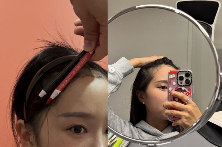 [뉴시스]헤이지니가 헤어라인에 모발 이식 수술을 받았다. (사진 = 헤이지니 인스타그램 캡처) *재판매 및 DB 금지