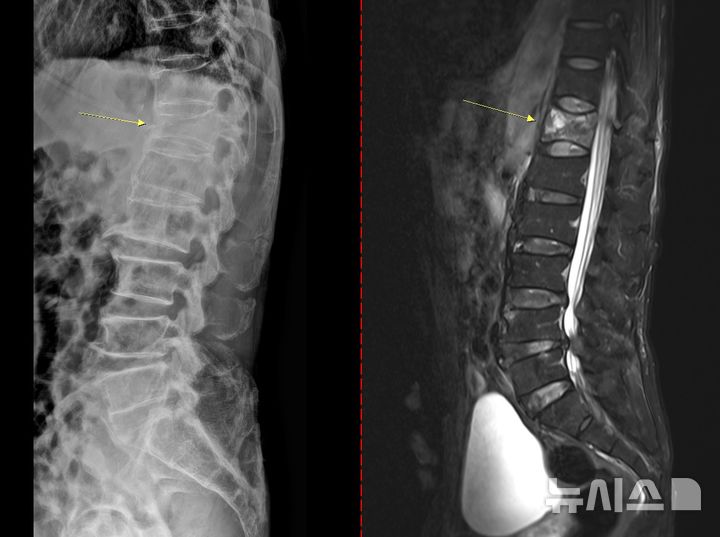 [서울=뉴시스] 골다공증성 압박골절 환자의 척추 엑스레이(왼쪽) 와 MRI(오른쪽). (사진= 고려대안산병원 제공)