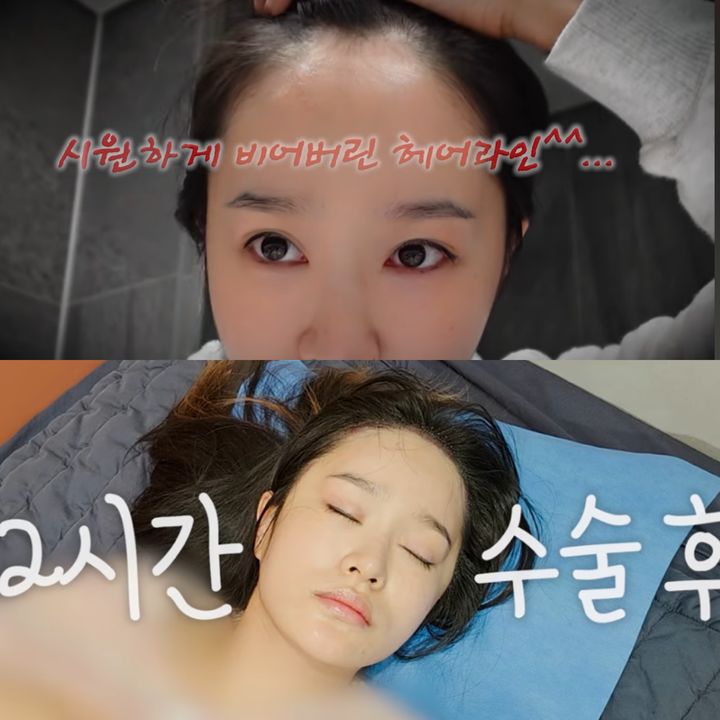 "듬성 비었었는데…" 헤이지니, 모발이식 비포·애프터 공개