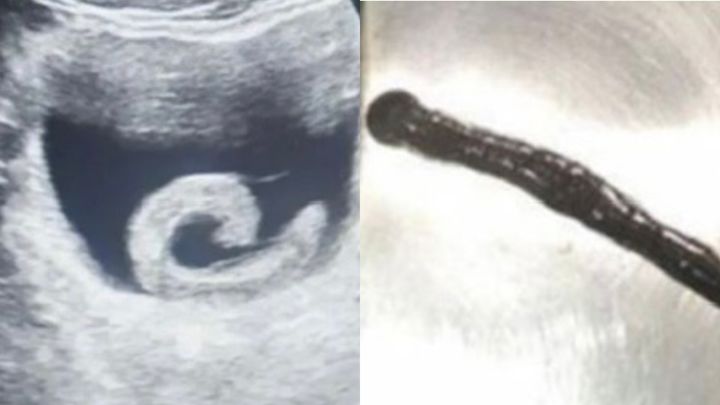 잘못된 민간요법…요도에 꿈틀거리는 '이것' 넣었다가 병원행