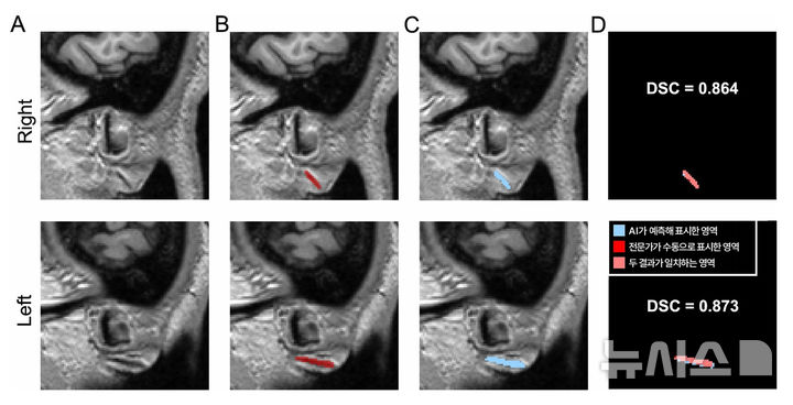 [서울=뉴시스] 3차원 원본 이미지(A)를 토대로 전문가가 수동으로 직접 표시한 주름(B)과 AI가 예측해 자동으로 표시한 영역(C). DSC 값은 두 영역의 겹침 정도를 수치화한 것으로, AI가 전문가와 거의 일치하게(약 87%) 주름을 찾아냈다는 의미를 가진다. (사진= 분당서울대병원 제공)