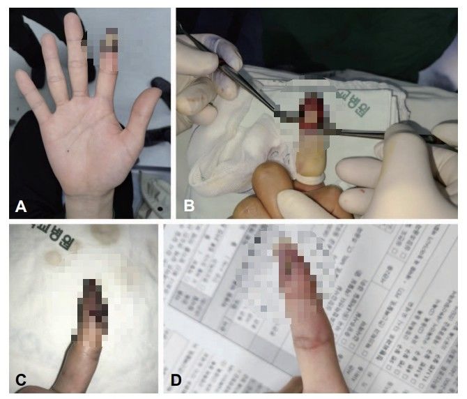 [서울=뉴시스] 12일 의료계에 따르면 하유라·정진우·정성윤 동아대병원 의료진과 심정용 대한민국 육군은 이 같은 사례를 정리한 증례 보고서 '프랄리독심 자동주사기에 의해 발생한 손가락 구획증후군'을 대한응급학회지 최근호에 발표했다. 사진은 해당 치료 모습의 일부. (사진=대한응급학회지 캡처) 2026.01.12. photo@newsis.com *재판매 및 DB 금지