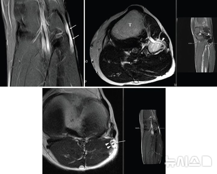 [서울=뉴시스] 허리에서 시작해 엉덩이 뒤쪽을 지나 다리 뒤편 허벅지, 종아리를 따라 발까지 내려가는 우리 몸에서 가장 크고 굵은 신경 다발인 좌골신경에서 발생한 희귀 난치성 양성종양 '신경내 결절종'(화살표 부분) MRI 영상 검사 사진. (사진= 서울성모병원 제공)