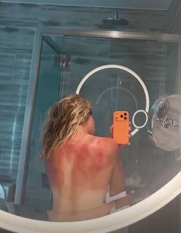 여성 테니스 스타, 상반신 셀카…'온몸이 붉게 변했다' 무슨 일?