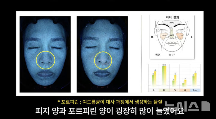 설탕·밀가루만 먹었더니…피부과 의사 피부 나이 5년 늙었다