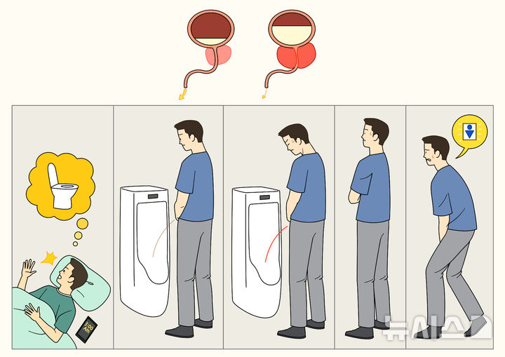 [서울=뉴시스] 보건복지부와 중앙암등록본부(국립암센터)가 발표한 '2023년 국가암등록통계'에 따르면 전립선암이 폐암을 제치고 통계 공표 이래 처음으로 남성 암 발생률 1위에 올랐다. (사진= 유토이미지 제공)