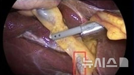 육안으로 구별 어려운 담낭절제삼각…"AI, 정확히 식별"