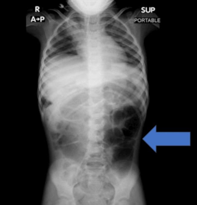 [뉴시스] 복통을 호소하던 6세 여아의 위장 안에서 예상치 못한 이물질이 발견된 사례가 학술지에 보고됐다. (사진=큐레우스 저널) *재판매 및 DB금지 *재판매 및 DB 금지