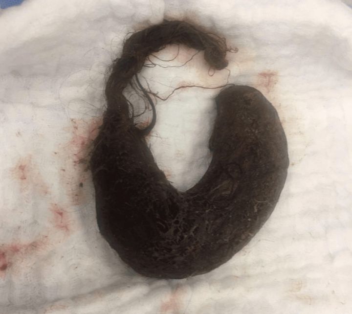 [뉴시스] 다량의 머리카락이 엉켜 형성된 덩어리. (사진=큐레우스 저널) *재판매 및 DB금지 *재판매 및 DB 금지