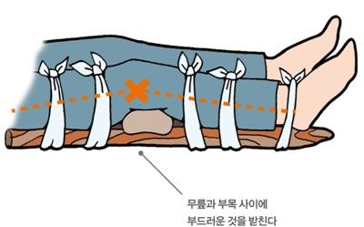 [대구=뉴시스] 전문가들은 부상 직후 정확한 진단 전까지는 RICE 요법을 적용해야 한다고 조언한다. (사진=박종수 율하바른정형외과 제공) 2026.01.24. photo@newsis.com *재판매 및 DB 금지