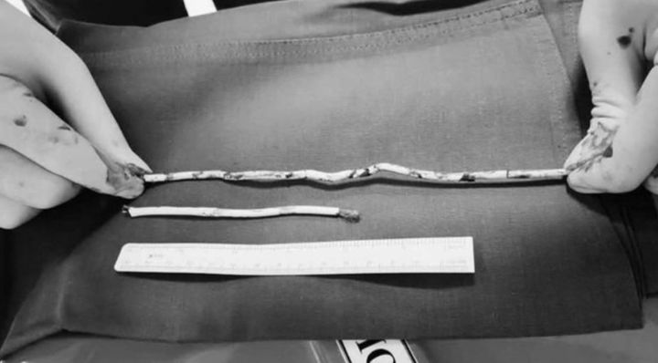 [뉴시스] 15세 소년의 요도 내부에서 제거된 약 35㎝의 케이블 (사진=엑스 캡처) *재판매 및 DB 금지