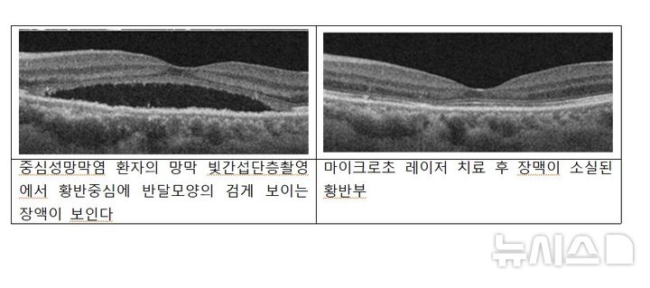 [서울=뉴시스] 중심성망막염 신(新) 치료 전략 제시. (사진= 여의도성모병원 제공)