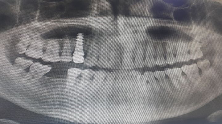 [서울=뉴시스] 28일 의사협회 의료광고심의위원회에 따르면 수년전 이미 '수면 임플란트'라는 표현이 환자에게 시술의 위험성을 간과하게 하고 치료 효과를 오인하게 할 우려가 크다고 판단해 해당 용어 사용을 불허했다. 해당 사진은 기사와 직접 관련이 없습니다. (사진=유토이미지 제공) 2026.01.28. photo@newsis.com *재판매 및 DB 금지