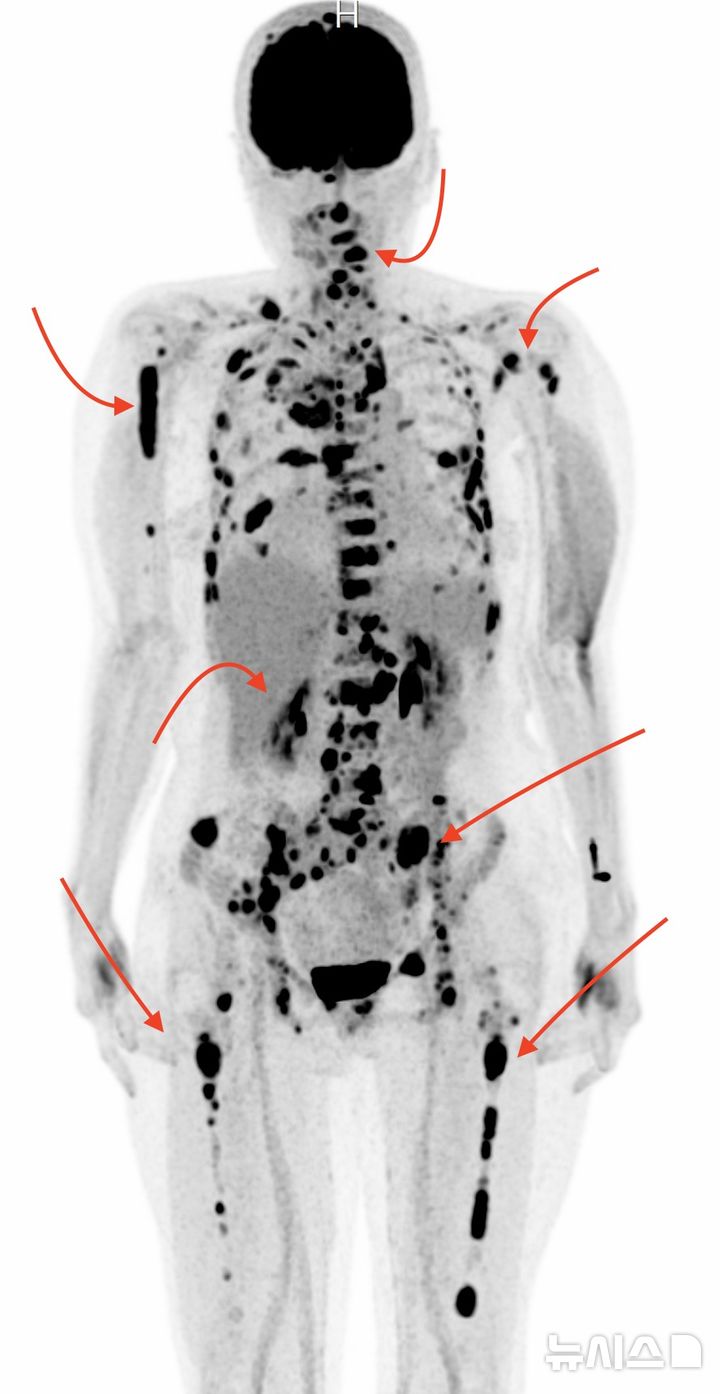 [서울=뉴시스] 전구진단 선별 없이 다발골수종으로 진단된 중증 환자의 PET CT 영상. (사진= 서울성모병원 제공)