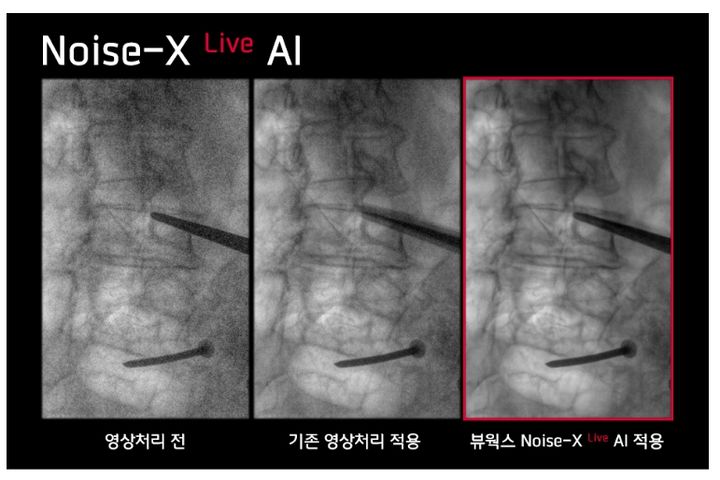 [서울=뉴시스] 뷰웍스가 지난해 12월 '북미영상의학괴(RSNA) 2025'에서 동영상 엑스레이 딥러닝 기반 노이즈 저감 솔루션 '노이즈엑스 라이브(Noise-X Live AI)'를 처음 선보이며 이목을 끌었다. (왼쪽부터)영상처리 전, 기존 영상처리 적용, 노이즈엑스 라이브 사용. (사진=뷰웍스 제공) 2026.01.29. photo@newsis.com *재판매 및 DB 금지