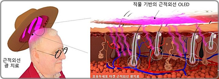 [대전=뉴시스] KAIST-홍콩과기대가 개발한 직물 기반 근적외선 OLED 광 탈모치료 기술 모식도.(사진=KAIST 제공) *재판매 및 DB 금지