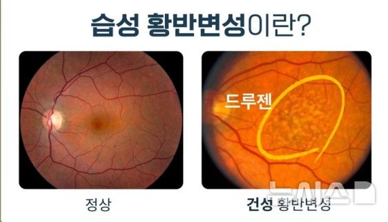 "사물이 굴곡져 보여요"…혹시 실명 유발 '이 질환' 신호?[몸의경고]