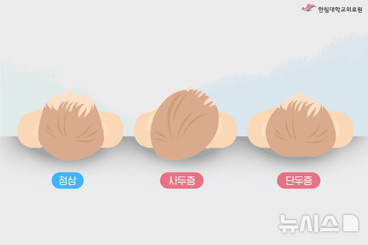 [서울=뉴시스] 자세형 사두증의 유형. (사진= 한림대동탄성심병원 제공)