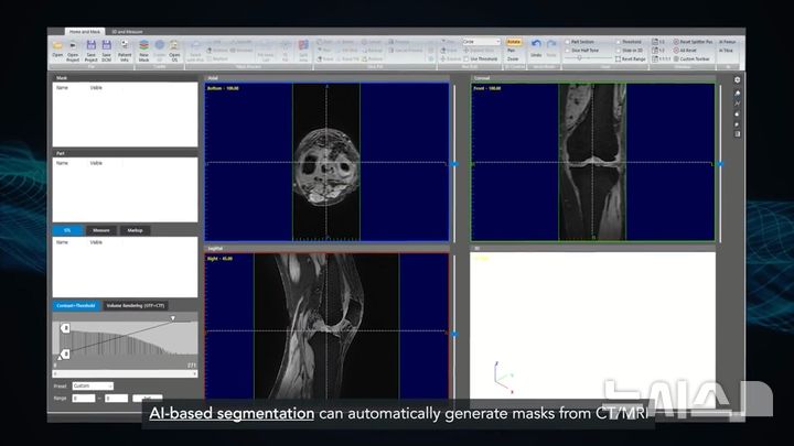 [서울=뉴시스] AI를 활용해 무릎 연골을 3차원으로 정밀 재현하는 ZIFT. (사진= 연세사랑병원 제공) 