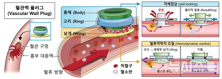 [서울=뉴시스] 연구팀이 개발한 혈관벽플러그 개요. (사진= 세브란스병원 제공)
