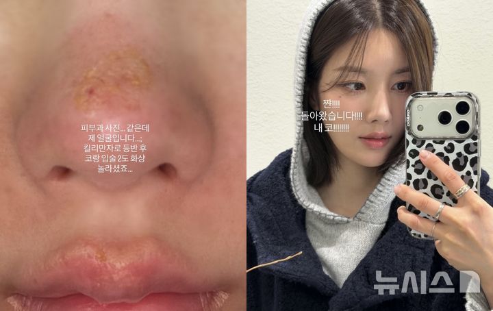 [서울=뉴시스] 가수 권은비가 아프리카 최고봉 킬리만자로 등반 도중 얼굴에 2도 화상을 입은 근황을 공개했다. (사진 = 권은비 인스타그램 캡처) 2026.02.04. photo@newsis.com *재판매 및 DB 금지