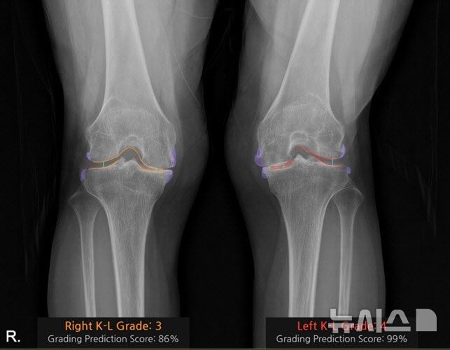 [서울=뉴시스] 코넥티브 인공지능 관절염 판독 솔루션 '코네보 코아'(CONNEVO KOA)를 적용해 'KL 등급'(켈그렌-로렌스 등급)을 판독한 사진. 골극 변형(보라), 관절 간격(3단계 주황, 4단계 빨강)을 시각화 함. 'KL 등급'은 무릎 관절염의 진행 정도를 평가하는 데 사용되며 단계에 따라 치료 방향이 달라진다. (사진= 서울대병원 제공)