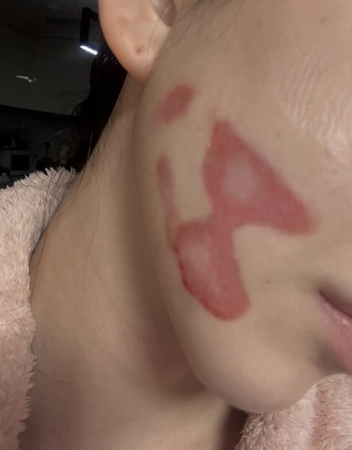 "2도 화상 공황발작" 권민아, '피부과 시술' 부작용 호소