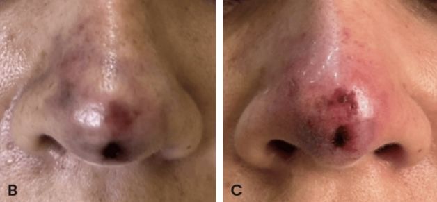 30대 여성, 코 필러 맞았다가 '피부 괴사' 직전까지…원인은?