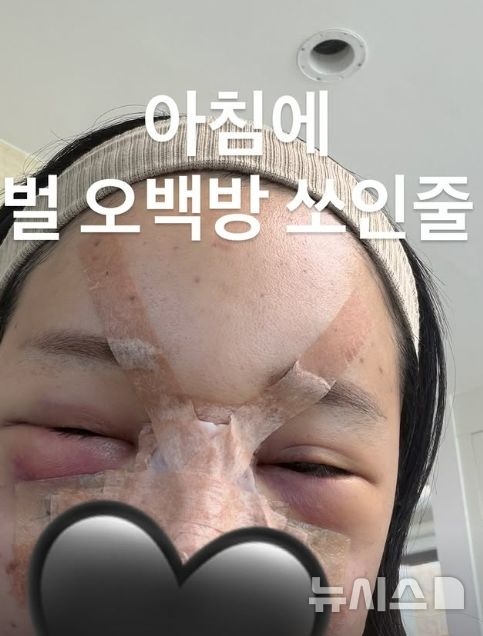 [서울=뉴시스] 유튜버 랄랄이 성형 수술 후 근황을 전했다. (사진 = 랄랄 인스타그램 캡처) 2026.02.18. photo@newsis.com *재판매 및 DB 금지