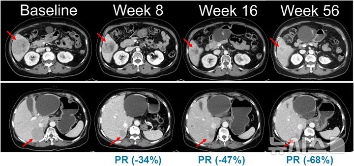 [서울=뉴시스] 한미약품은 악성 피부암인 흑색종 치료를 위한 표적 항암신약 '벨바라페닙'의 국내 임상 2상에서 환자에게 투약을 시작했다고 19일 밝혔다. 사진은 NRAS 돌연변이 흑색종 환자를 대상으로 진행된 벨바라페닙과 코비메티닙 병용요법 임상시험에서 시간 경과에 따른 병변 변화가 관찰된 복부 CT 영상.(사진=한미약품 제공) 2026.02.19. photo@newsis.com