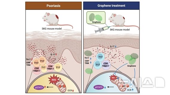 쉽게 재발하는 '건선'…근본 원인 조절 '새 치료법' 제시
