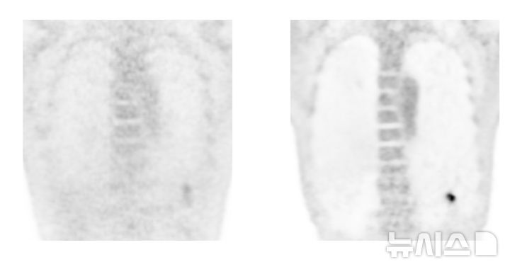 [서울=뉴시스] AI(인공지능) 적용 전(좌)과 적용 후(우) 폐결절 PET-CT 사진. AI 적용 전에는 호흡에 의해 폐결절이 흔들려 보이며 영상의 잡음이 심하지만 AI 적용 후에는 호흡이 보정돼 폐결절이 선명하게 보이며 영상의 질도 개선됐다. (사진= 한림대학교강남성심병원 제공)