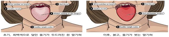 [대구=뉴시스]제2급 법정감염병 '성홍열' 증상 그래픽(사진=대구시 제공) 2026.02.26 photo@newsis.com *재판매 및 DB 금지