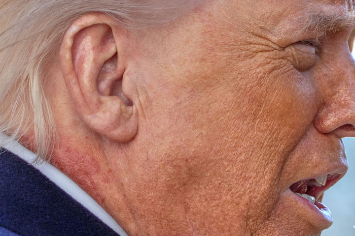 [워싱턴=AP/뉴시스] 도널드 트럼프 미국 대통령이 2월 27일(현지 시간) 워싱턴 백악관에서 마린원 헬기 탑승 전 기자들과 이야기 하고 있다. 그의 오른쪽 목에 붉은 반점이 보이고 있다. 2026.03.03.