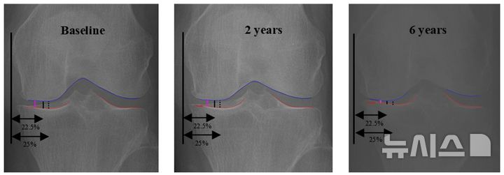[서울=뉴시스] 초기, 2년, 6년 시점별 관절 간격 측정 비교. AI가 찾은 oJSW(보라색)가 기존 방식(검은색)보다 정밀한 추적 관찰을 가능하게 한다. (사진= 서울대병원 제공)