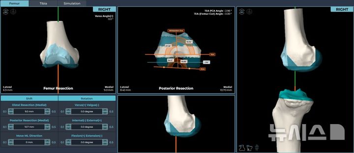 [서울=뉴시스] AI를 활용해 무릎 구조를 3D로 정밀하게 구현하는 OnKnee-U(TKR). (사진= 연세사랑병원 제공)