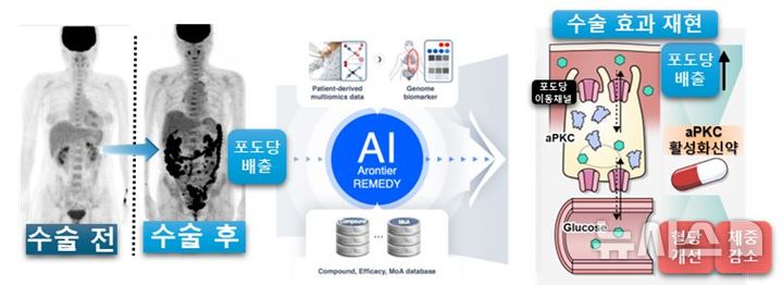 [서울=뉴시스] 비만대사수술 후 혈당 개선의 주요 기전으로 제시된 장내 포도당 배출현상을 기반으로, AI 기반 신약개발 플랫폼을 통해 핵심 분자 기전인 aPKC·GLUT1 신호축 및 해당 기전을 조절할 수 있는 약물 후보를 도출했다. (사진= 세브란스병원 제공)