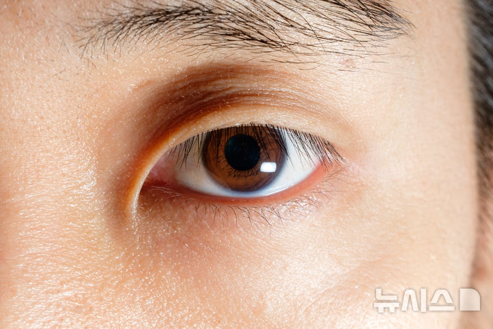[서울=뉴시스] 안검내반은 눈꺼풀이 안쪽으로 말려 들어가면서 속눈썹이 각막과 결막을 지속적으로 자극하는 질환이다. (사진= 유토이미지 제공)
