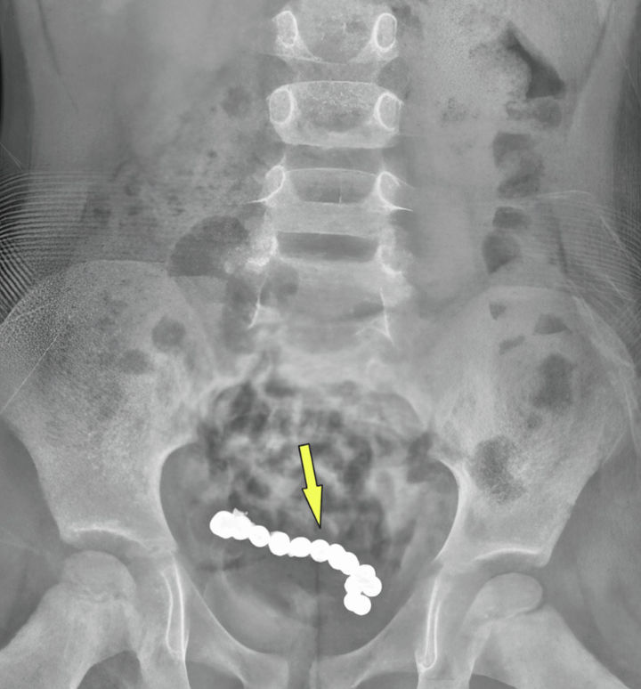 [뉴시스]1년 동안 복통을 호소한 4세 남아의 뱃속에서 22개의 자석 조각이 발견돼 충격을 주고 있다. (사진 = 큐레우스 캡처) *재판매 및 DB 금지