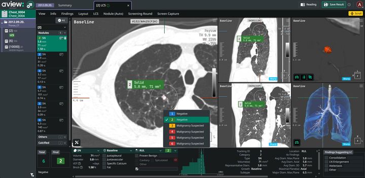 [서울=뉴시스] 16일 코어라인소프트에 따르면 AVIEW LCS는 폐결절 자동 검출과 정량 분석을 기반으로 이전 검사와의 비교, 성장 속도 분석 등 추적관리 기능을 제공한다. (사진=코어라인소프트 제공) 2026.03.16. photo@newsis.com *재판매 및 DB 금지