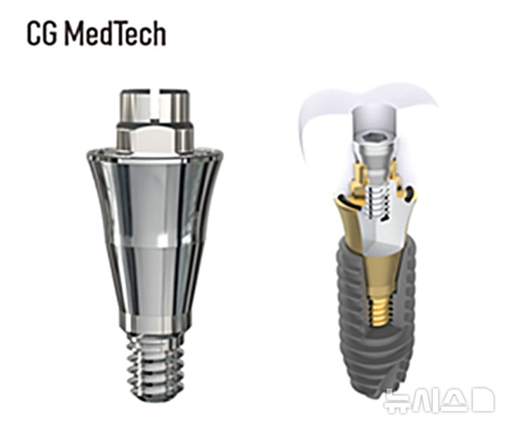 [서울=뉴시스] 시지메드텍은 치과 임플란트 보철 신제품 '우루덴트 SA'를 출시했다고 18일 밝혔다. (사진=시지메드텍 제공) 2026.03.18. photo@newsis.com
